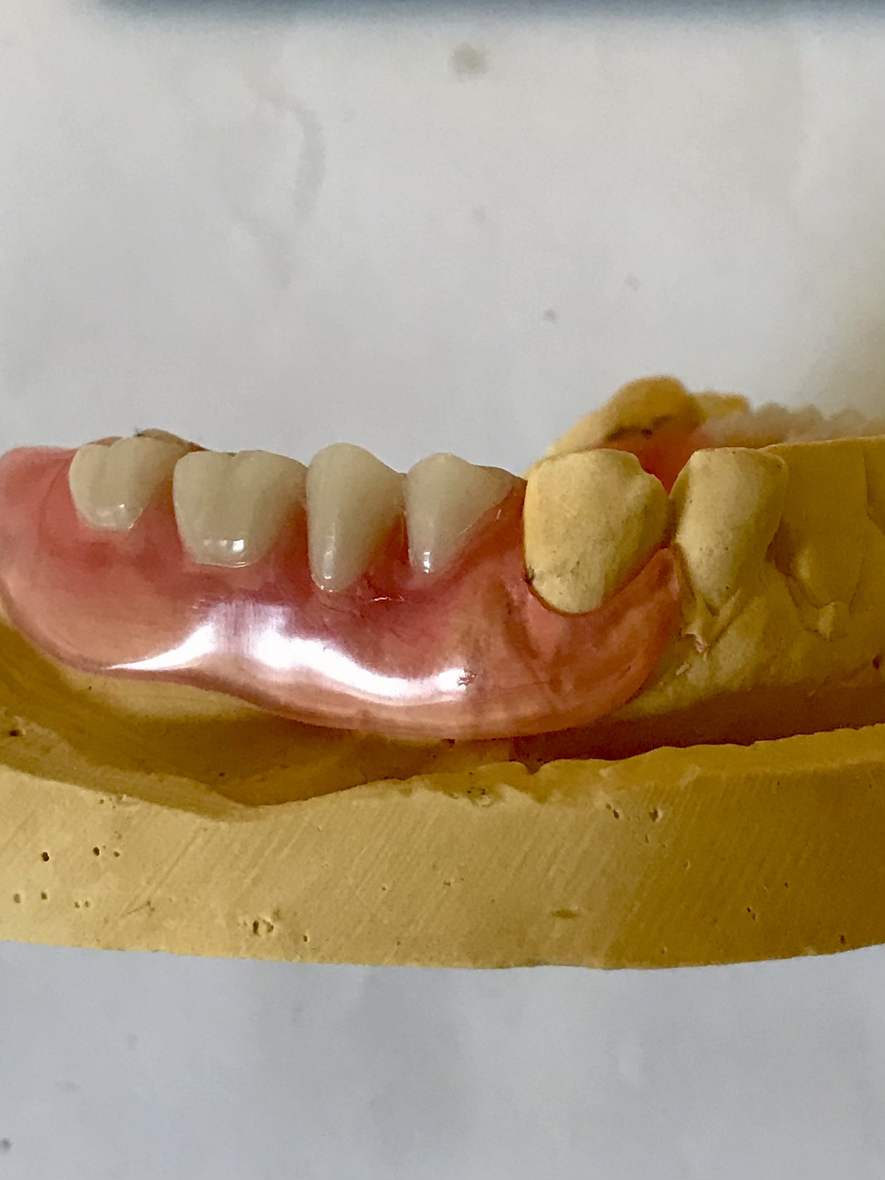 partial Valplast denture