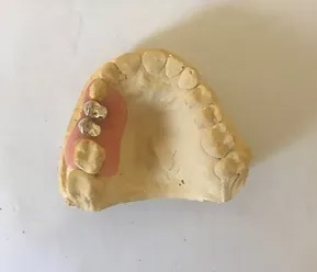 Valplast dental insert