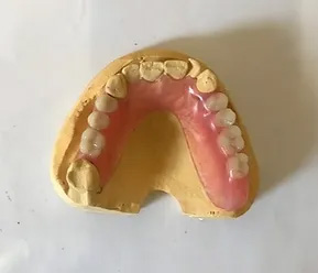 Valplast partial denture