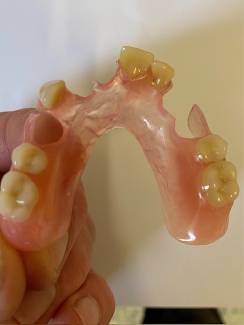 Valplast denture after trimming