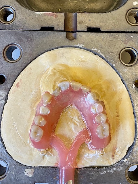 Molding a Valplast denture